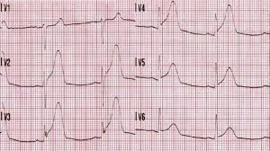 Image result for ST Elevation