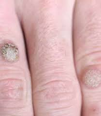 Best reviews guide analyzes and compares all wart treatments of 2021. Best Wart Removal Treatment In Hyderabad Warts Removal Cost Clinic In Hyderabad