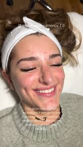 Hydrated, healthy skin with targeted acne support., This treatment helps  minimize swelling, reduce sensitivity, and promote effective wound healing  for compromised skin. , #salonearté #facials ...