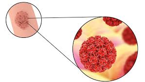 La barbati infectia cu virus papiloma, mai ales cu tipurile 16 sau 18 poate favoriza, in rare cazuri, in conditii de imunitate scazuta sau la persoanele mai in varsta. Negii Verucile Reginamaria Ro