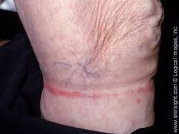 Contact dermatitis usually affects areas of skin directly exposed to an offending substance. Contact Dermatitis 101 How To Manage This Form Of Eczema