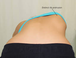 تأثير اعوجاج العمود الفقري على شكل الظهر من الخلف