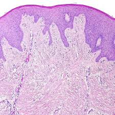 Tartar is far more porous. Pdf Surgical Approach To Snus Induced Injury Of The Oral Mucosa