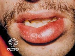 Image result for Angioedema