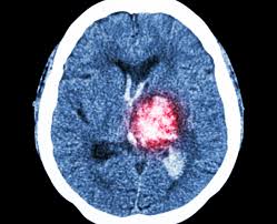 L'emorragia cerebrale è una fuoriuscita più o meno copiosa di sangue da un vaso arterioso o venoso altre fondamentali cause di sanguinamento intracerebrale sono le malformazioni vascolari. Emorragia Cerebrale I Sintomi Per Riconoscerla Fondazione Umberto Veronesi