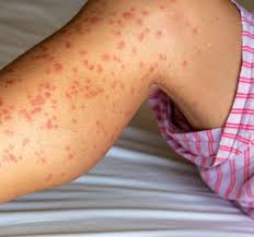 Image result for Papular urticaria