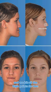 The general public’s perception of an oral surgeon tends to include  procedures like jaw surgery, wisdom teeth removal, and dental implants.  Believe it or not, cosmetic facial surgery is a very common ...
