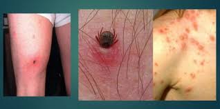 Check spelling or type a new query. Enfermedades Infecciosas Causas Y Factores De Riesgo Del Tifus