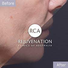 What is the best way to get rid of jowls? How To Get Rid Of Saggy Jowls