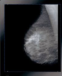 Breast cancer breast cancer is the second leading cause of cancer in women. Breast Cancer Detection Improved With Image Processing