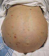 Cirrhosis Wikipedia