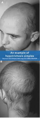 It might be normal for infants to lose some parts of hair before growing permanent hair, but if your child is suddenly developing bald patches or is losing hair more than usual, then it may not be normal. New Gene Discovered That Causes Rare Hair Loss From Childhood