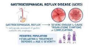 Image result for Pediatric Reflux