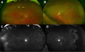 Vancomycin-Associated Hemorrhagic Occlusive Retinal Vasculitis