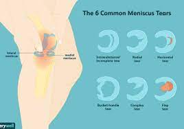 Check spelling or type a new query. 6 Types Of Meniscus Tears And Locations