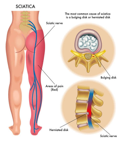 Sciatic Nerve Referral Pathway, AI generated