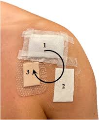 Image result for Occlusive Dressing