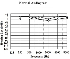 classification of hearing loss intechopen