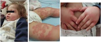 Image result for Urticaria pigmentosa children