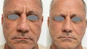 Fotona 4D Laser Lift London | Fotona 4D Laser Cost & Prices