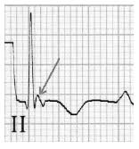 Image result for Epsilon Wave