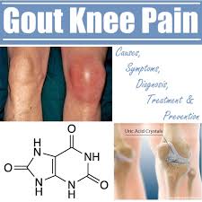 Image result for gout symptoms knee