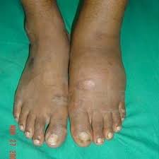 Charcot foot refers to an inflammatory pedal disease based on polyneuropathy; Charcot Foot Is Often Missed In Diabetics Health24