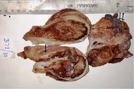 Malignant mesothelioma is a rare form of cancer that affects the lining of the lungs, abdomen, heart, and major organs in the body. Calretinin Negative Paratesticular Mesothelioma A Rare Case Report Springerlink