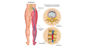 Große auswahl an right foot. 5 Sciatica Symptoms To Look For What Are The Symptoms Of Sciatica