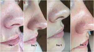 There are a lot of steps to the zo skin health line, so i suggest that you make an appointment with dr. Zo Skin Health Offects Te Pads Acne Pore Treatment Review Really Ree