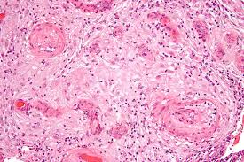 Rarely, preeclampsia develops after delivery of a baby, a condition known as postpartum preeclampsia. Pre Eclampsia Wikipedia