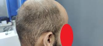 Nordwood scale 7; thin donor are