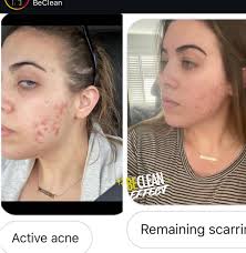 The BeClean effect is real! Making the bad skin good & the good skin great  ✨😎 #BeClean #ForMenAndWomen #BecomeNutrition #skin ✨Testimony page:  @becleaneffect ✨ Grab your bottle: @becomenutrition