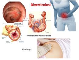 La stenosi diverticolare sintomatica del colon è un'occlusione dovuta a diverticoli infiammati che vanno rimossi. Le Stenosi Del Colon