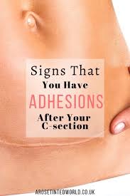 You should expect to need help. Adhesions After A C Section A Rose Tinted World