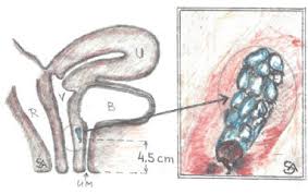 Condiloamele sunt condiloame genitale, care sunt una dintre manifestările infecției femeilor cu virusul papilomavirus. Negi In Zona Genitala La Femei Poze Steenbecquevillage Fr