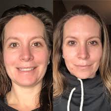 Does Botox cause lupus flares?