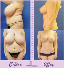 Check spelling or type a new query. Breast Reduction Surgery What You Need To Know