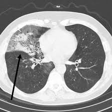 Pneumonia can be generally defined as an infection of the lung parenchyma, in which consolidation of the sections bacterial pneumonia. Pdf Pneumonia Lipoidica E A Importancia Da Historia Clinica Para O Diagnostico Diferencial Relato De Caso