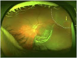 We did not find results for: Incidence Mechanism And Outcomes Of Schisis Retinal Detachments Revealed Through A Prospective Population Based Study British Journal Of Ophthalmology