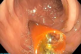 Image result for Bezoar