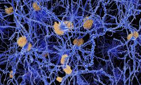 Learn about alzheimer's symptoms, causes, tests and treatments. Alzheimer Protein Fehlfaltung Ist Ubertragbar Wissenschaft De