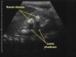 Kidney Sonography Medicina Nemoci Studium Na 1 Lf Uk Diagnostic Medical Sonography Sonography Ultrasound
