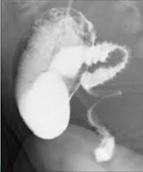 Image result for Midgut Volvulus