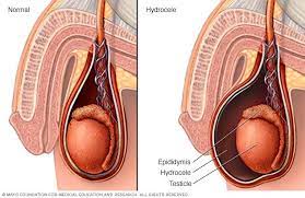 Signs and symptoms of testicular cancer include: Scrotal Masses Symptoms And Causes Mayo Clinic