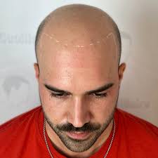 SWIPE LEFT ⬅️ BEFORE PICTURE Bring back your confidence with SCALP  MICROPIGMENTATION Instant, natural & long-lasting results... A quick,  effective solution ! NO surgery & NO complicated maintenance... Choose your  look: Natural