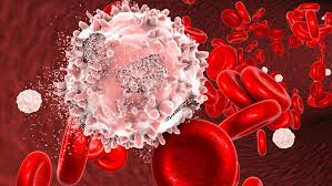 Día Mundial de la Leucemia: la importancia de los síntomas para un  tratamiento oportuno - El Mostrador