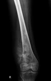 Image result for Osteosarcoma