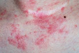 The word eczema comes from the greek word for bubbling. Atopic Dermatitis Hikes Risk Of Autoimmune Disorders