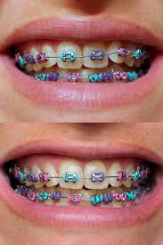 Blue is the most popular color for braces, especially boys like this color. Purple Sky Blue Light Blue Braces Novocom Top